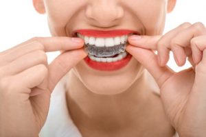 Types of braces and how to choose the right one