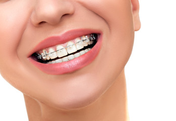 Types of braces and how to choose the right one